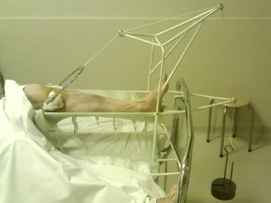 A photography shows a patient’s leg in skeletal traction.