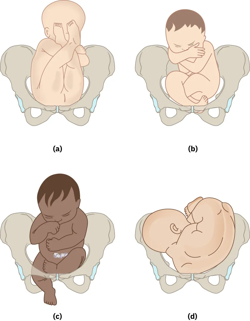 Breech position images: (a) frank breech: bottom first, legs straight up toward head, (b) complete breech: bottom first, legs crossed, (c) footling breech: one leg first, and (d) shoulder presentation: shoulder first.