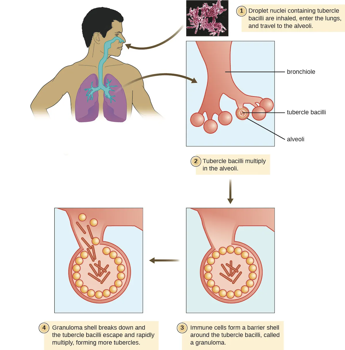 Diagram showing infectious cycle of tuberculosis. First a droplet nuclei containing tubercle bacilli are inhaled, enter the lungs and travel to the alveoli. Next, the tubercle bacilli multiply in the alveoli. Next, the immune cells form a barrier shell around the tubercle bacilli, called a granuloma. Finally, the granuloma shell breaks down and the tubercle bacilli escape and rapidly multiply forming more tubercles.