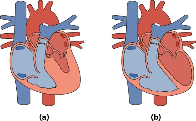 (a) Diagram showing diastolic heart failure with thick heart walls; (b) Diagram showing systolic heart failure with thin heart walls.