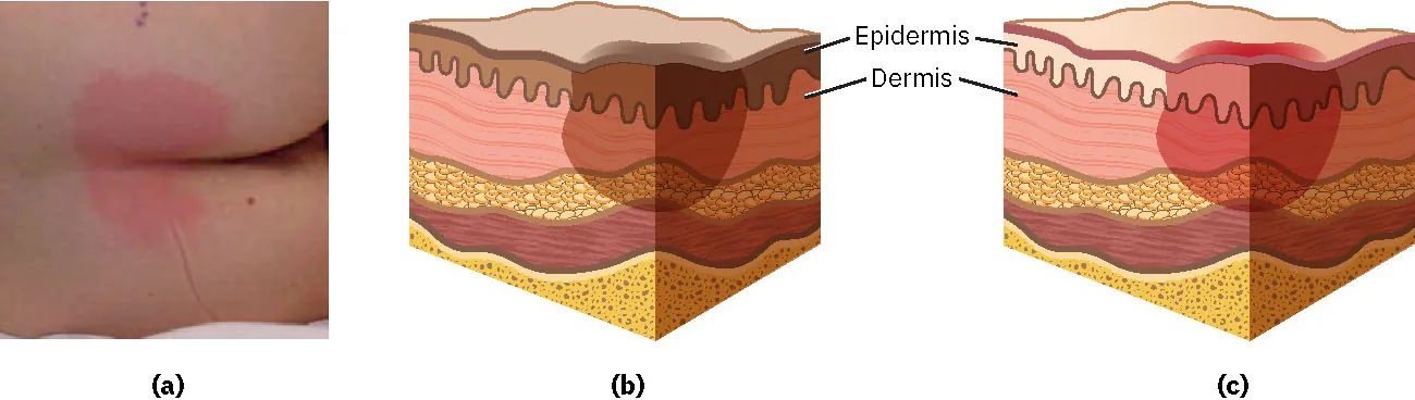 A three-panel image with one photograph showing stage 1 pressure injuries and two diagrams showing pressure injuries. The photograph shows a pressure image on buttocks with darkened portions where the pressure injuries are. The diagrams show darkened portions on the epidermis and dermis.