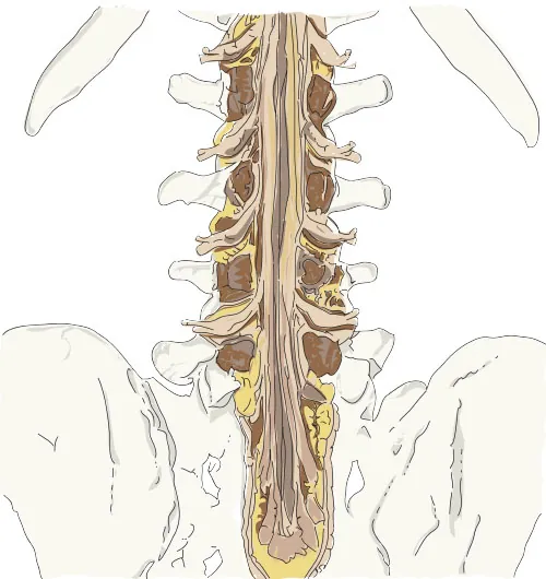 The image is an anatomical illustration showing a detailed view of the lower part of the spinal cord, specifically the cauda equina. The illustration highlights the bundle of spinal nerves and nerve roots extending from the lower end of the spinal cord. The surrounding vertebrae and pelvis bones are also depicted, providing context for the location of the cauda equina within the body. The spinal nerves are shown in yellow, while the vertebrae and bones are illustrated in neutral tones. This detailed view emphasizes the complexity and structure of the cauda equina within the lumbar spine region.