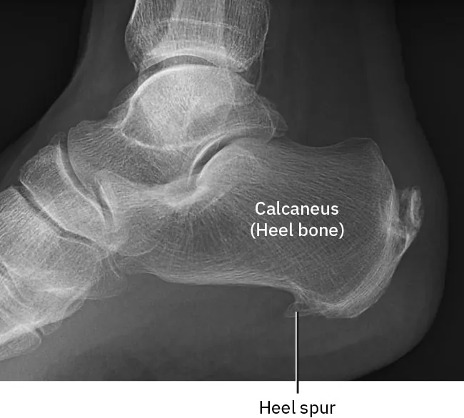 X-ray of bone spur, labeling Calcaneus (Heel Bone) and Heel Spur