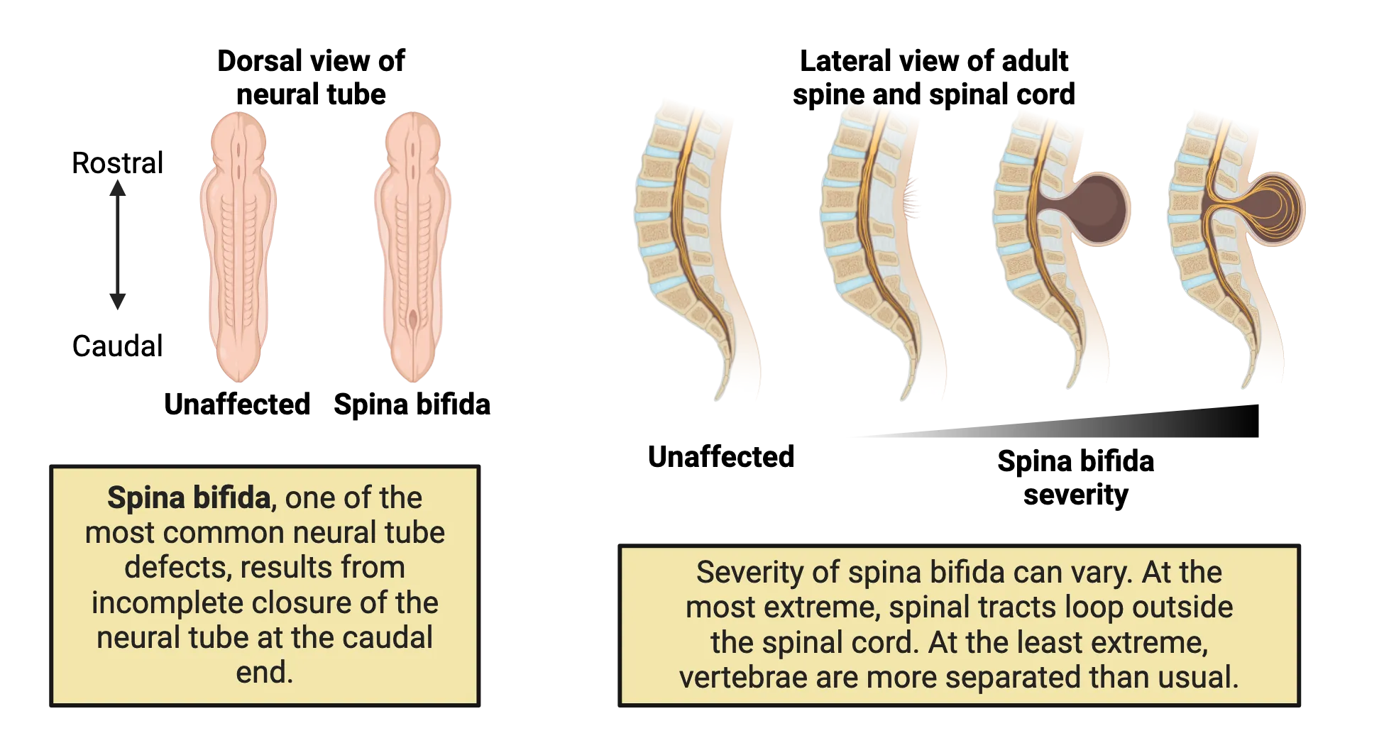 Left is a diagram of the dorsal view of a neural tube of an unaffected tube and a tube exhibiting spina bifida. The spina bifida tube has an opening at the caudal end of the tube that is absent in the unaffected tube. Right is a lateral view of adult spinal cord showing the variations in severity of spina bifida. In unaffected spine, neural pathways stay inside the spinal cord and vertebrae are in place. Variations of spina bifida shown include: missing vertebrae but nerves in place, missing vertebrae and some nerves looping out from the spinal cord dorsally, missing vertebrae and all nerves looping dorsally outside the spinal cord.