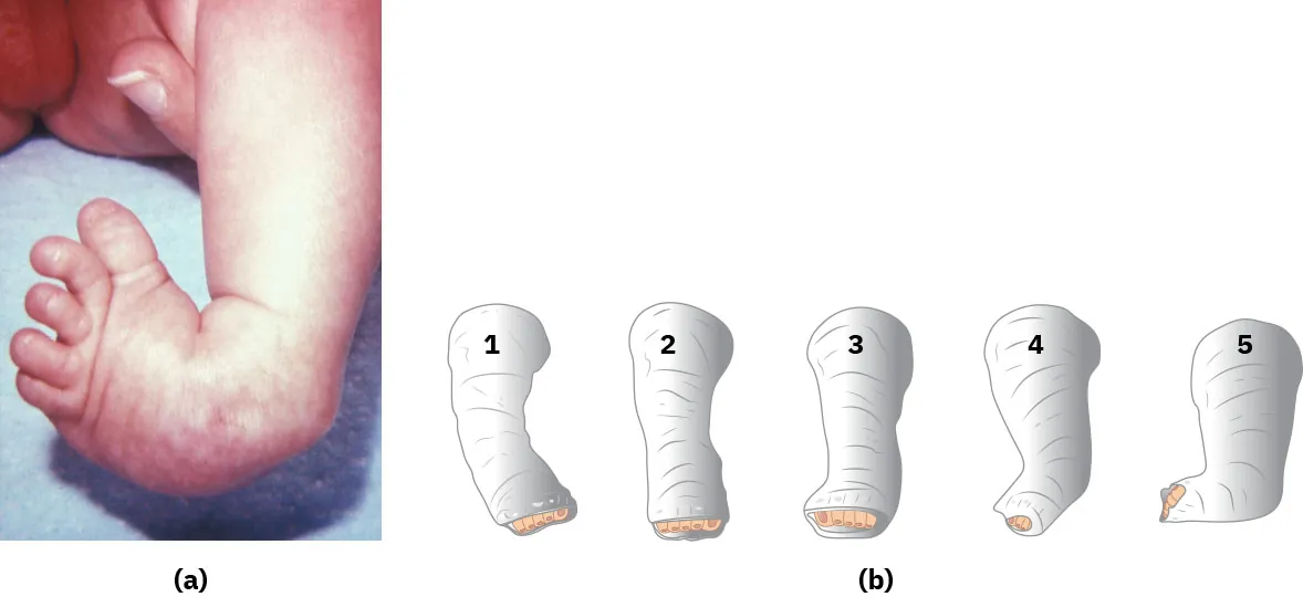 (a) Photograph of an infant with a clubfoot deformity. The foot is turned inward at the ankle. (b) Illustration of the different grades of clubfoot severity on a scale from one to five from mild (one) to severe (five).