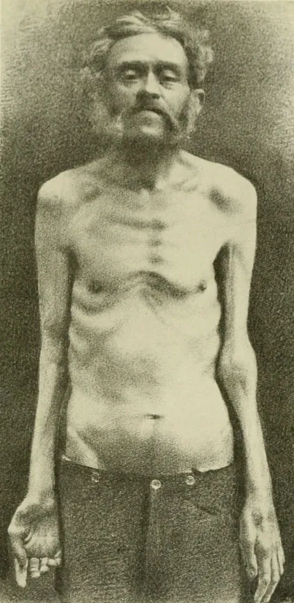 Person with muscle wasting and cachexia.