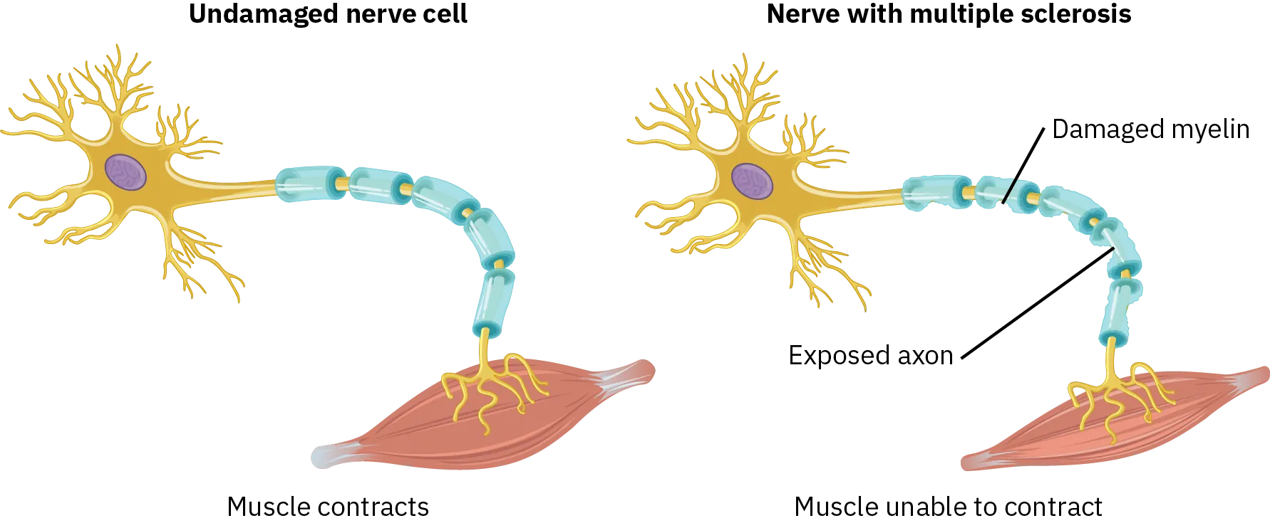 Two diagrams show an undamaged nerve cell and a nerve cell with multiple sclerosis. In the undamaged cell, myelin covers the axon and allows the muscle to contract. In the nerve cell with multiple sclerosis, the myelin is damaged and exposes parts of the axion. This results in a muscle being unable to contract.