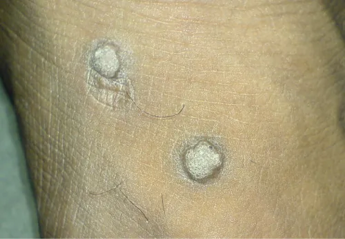 A color photograph shows an example verruca vulgaris