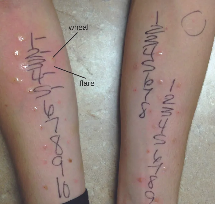 Photo of a person with many dots in a row on their skin. The dots are numbered and marks are next to those that are swollen.