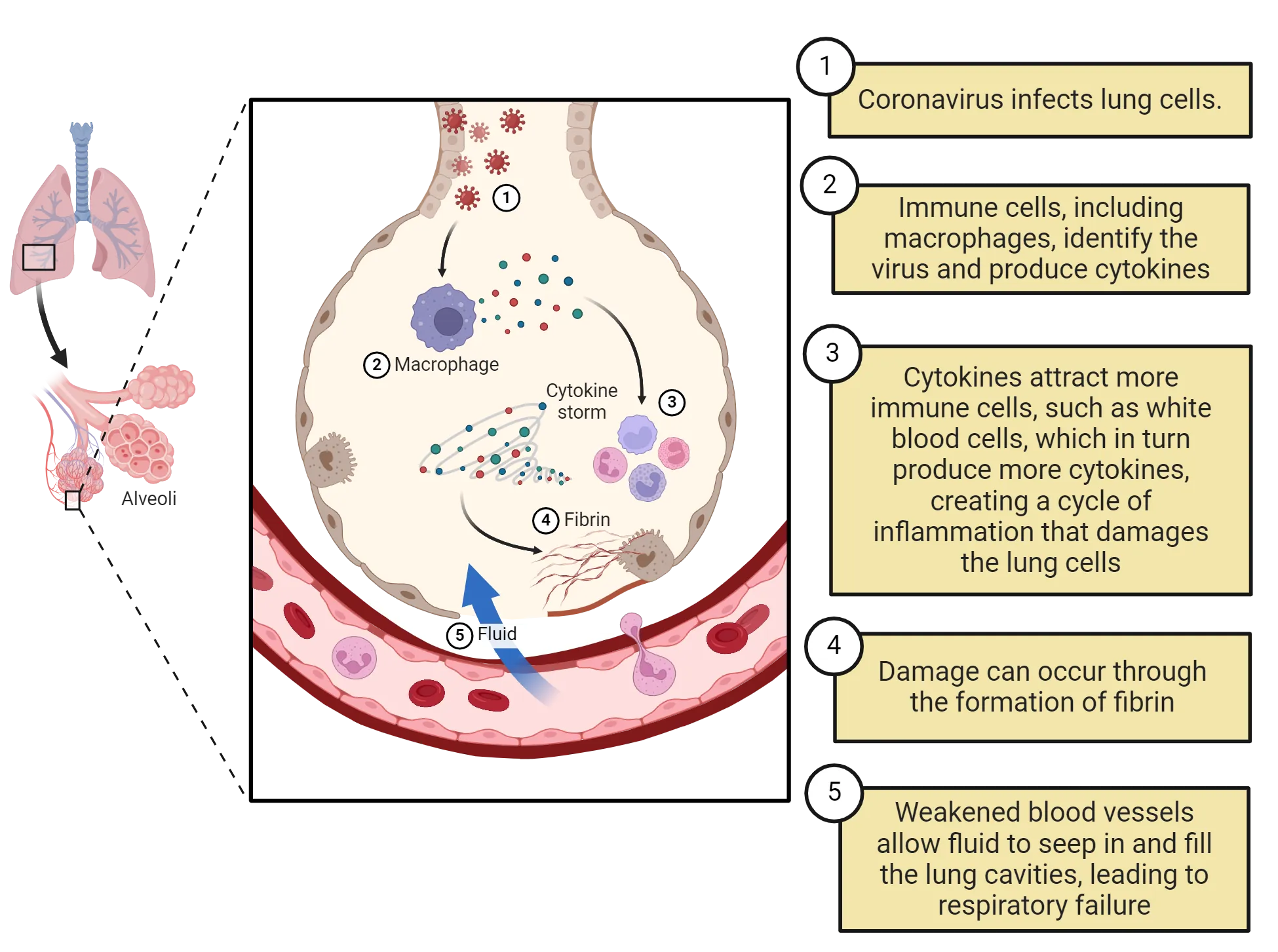Diagram showing human lungs with zoom-in on a single alveoli, which looks like a circular bag with blood vessel underneath it. Inside the alveoli, the following steps are diagrammed: 1. Coronavirus infects lung cells. 2. Immune cells, including macrophages, identify the virus and produce cytokines. 3. Cytokines attract more immune cells, such as white blood cells, which in turn produce more cytokines, creating a cycle of inflammation that damages the lung cells. 4. Damage can occur through the formation of fibrin. 5. Weakened blood vessels allow fluid to seep in and fill the lung cavities, leading to respiratory failure.