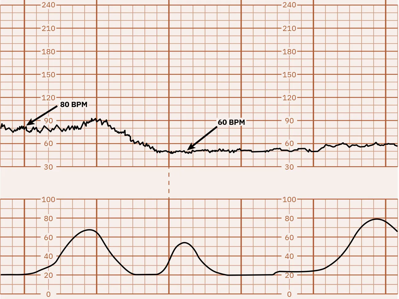 Fetal heart rate reading indicating bradycardia.