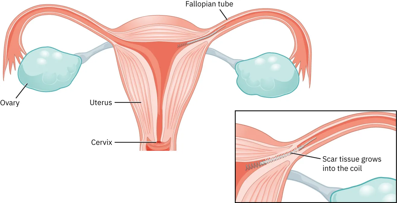 Image of intrauterine device inserted into fallopian tube. Inset image shows scar tissue forming around coiled intrauterine birth control device.