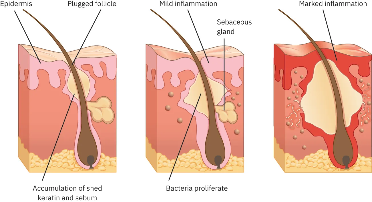 Three diagrams of acne with labels showing epidermis, plugged follicle, accumulation of shed keratin and sebum, mild inflammation, sebaceous gland, bacteria proliferate, and marked inflammation