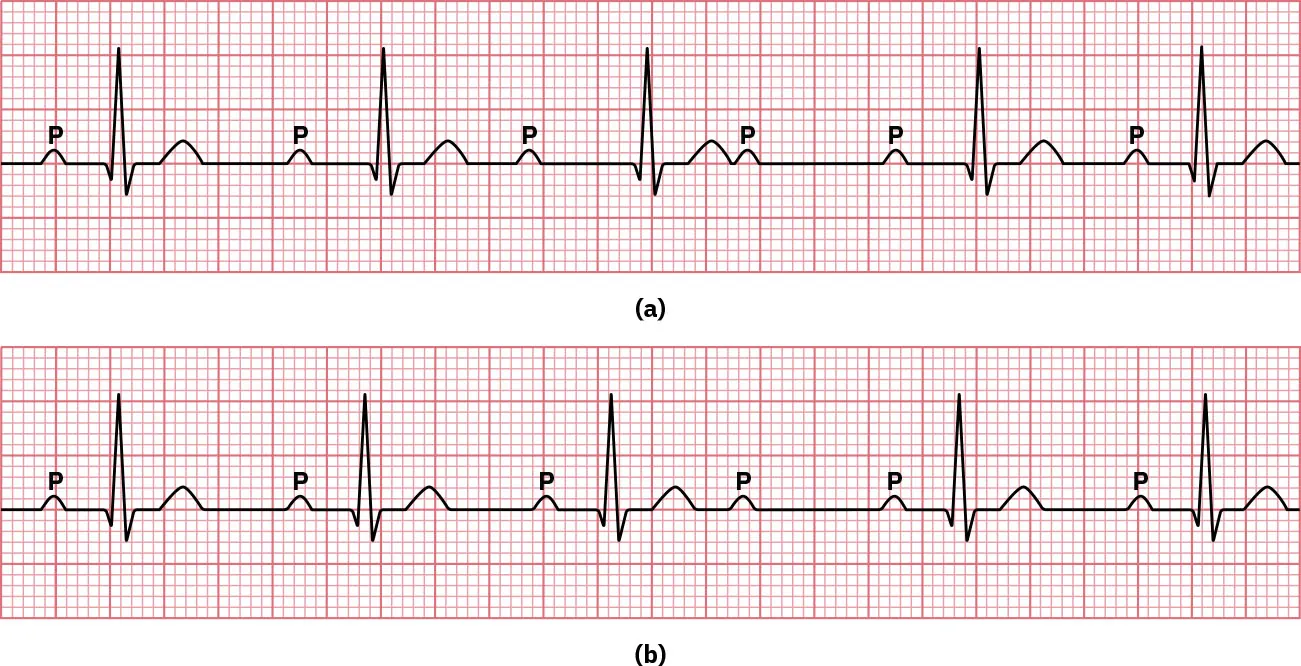 (a) Sinus rhythm showing Mobitz type I heart block with PR interval getting longer, QRS dropped, and width of QRS complex narrow.
