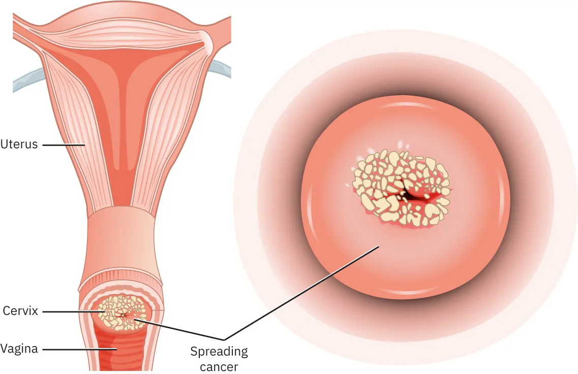 Image of cervix (at vagina and separate) displayed with small irregularly shaped cancer cells.