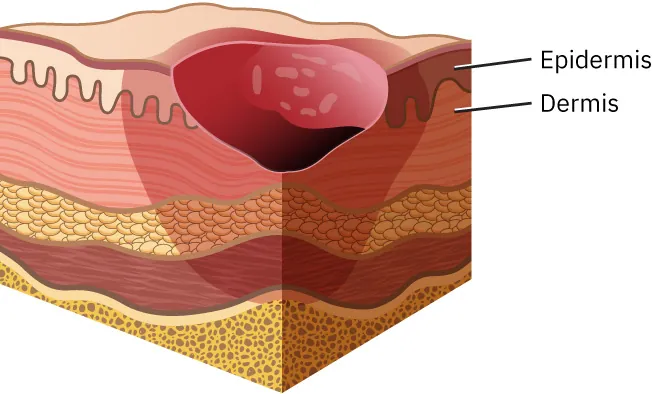 Stage II pressure injury and partial loss of skin.