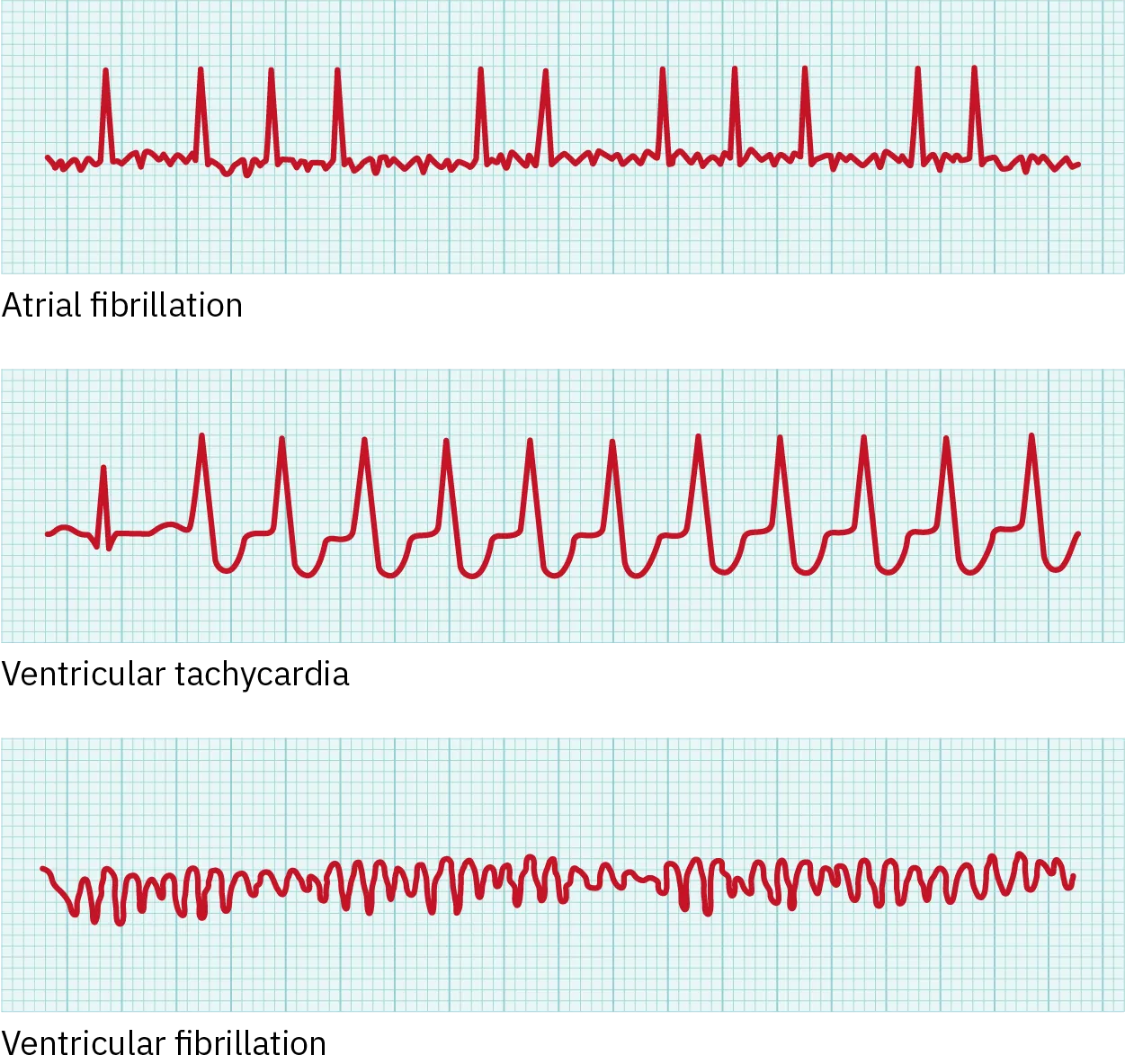 In this image the QT cycle for different heart conditions are shown. From top to bottom, the arrhythmias shown are atrial fibrillation, ventricular tachycardia, and ventricular fibrillation. For atrial fibrillation, the pattern before the Q R S complex is abnormal and the frequency between Q R S complexes has increased. For the ventricular tachycardia, the shape of the Q R S complex is unusual. For the ventricular fibrillation, the electric activity is completely abnormal.