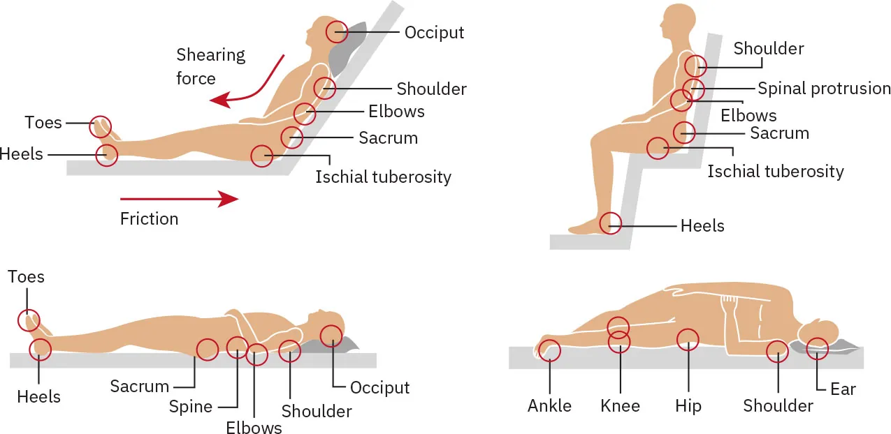 A diagram shows reclined, sitting, and laying positions which cause pressure injuries.