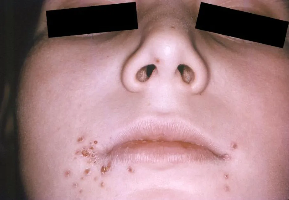 A photograph of a young face with numerous small cold sore lesions along the corners of the mouth and bottom lip.