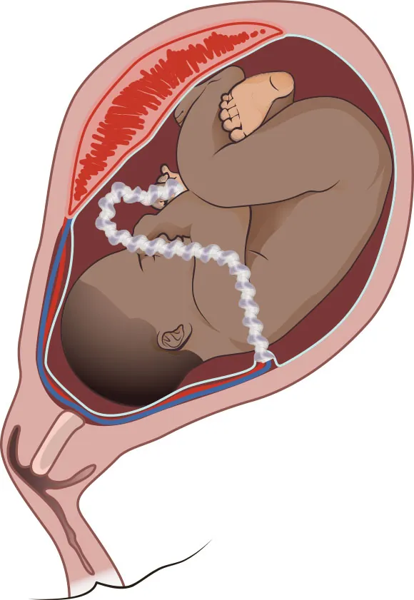 Image of fetus in uterus with vessels of placenta laying across the cervix opening.