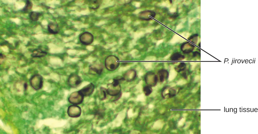 Micrograph showing green stained lug tissue and brown celled labeled P. jiroveci.