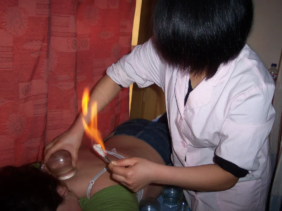A therapist holds a fire source in one hand and uses the other hand to apply a suctioned glass cup to the back of a person laying on their stomach.
