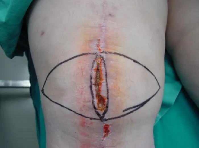 A photograph of a wound dehiscence in a patient’s knee with markings for debridement.