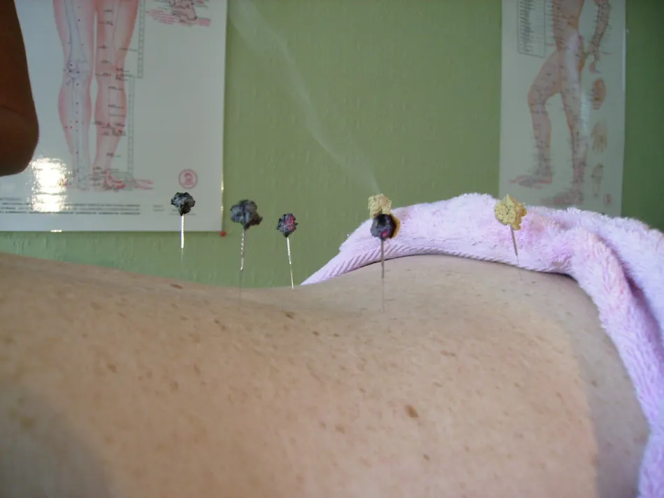 Photo of small needles inserted into an individual’s back. Tops of needles display smoky nodules.