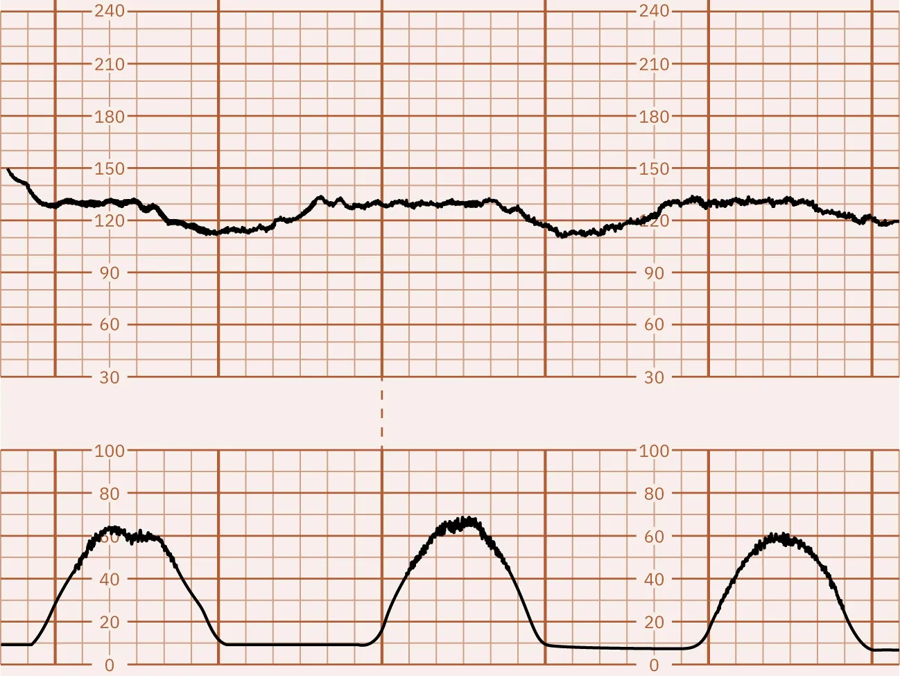 Fetal heart rate reading showing periodic changes. The top graph shows a fetal heart rate ranging from 150 bpm, but it drops down to 110 bpm at periodic intervals. The bottom graph shows contractions that peak just prior to the FHR dips.