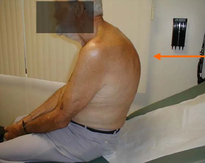 A color photograph shows a man siting on an examination table displaying signs of postural kyphosis.