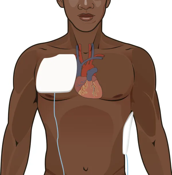 A color illustration showing an attached transcutaneous pacing electrode pad placed on a patient's chest to the side of the heart.