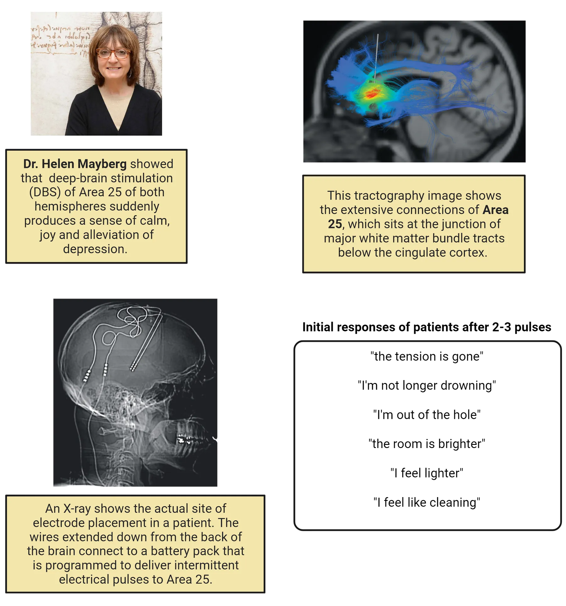 Top left: Photograph of woman, smiling. Top right: Brain image with colorful tracts shown extending from a focal point. Bottom left: Xray of human head showing electrodes in the brain space. Bottom right: Screenshot of quotes from patients. 