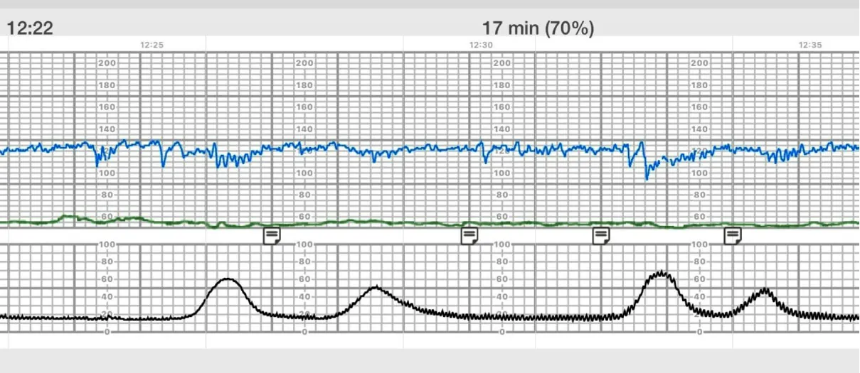 Image of contraction pattern.