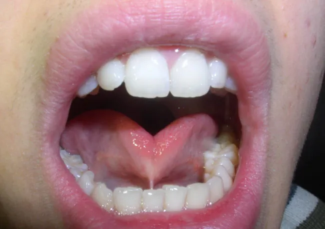 Photo of an open mouth showing the tongue attached by a frenulum to the bottom of the mouth.