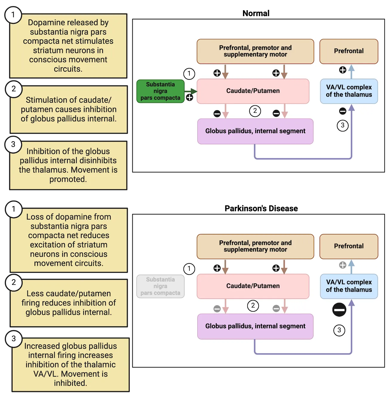 Top: A flow diagram of connections of the direct pathway with the substantia nigra pars compacta excitatory input to the caudate/putamen added in. Bottom: A flow diagram of connections of the direct pathway with the substantia nigra pars compacta excitatory input to the caudate/putamen shown as greyed out to represent it's loss in Parkinson's disease. The result is much greater inhibition of the VA/VL complex.