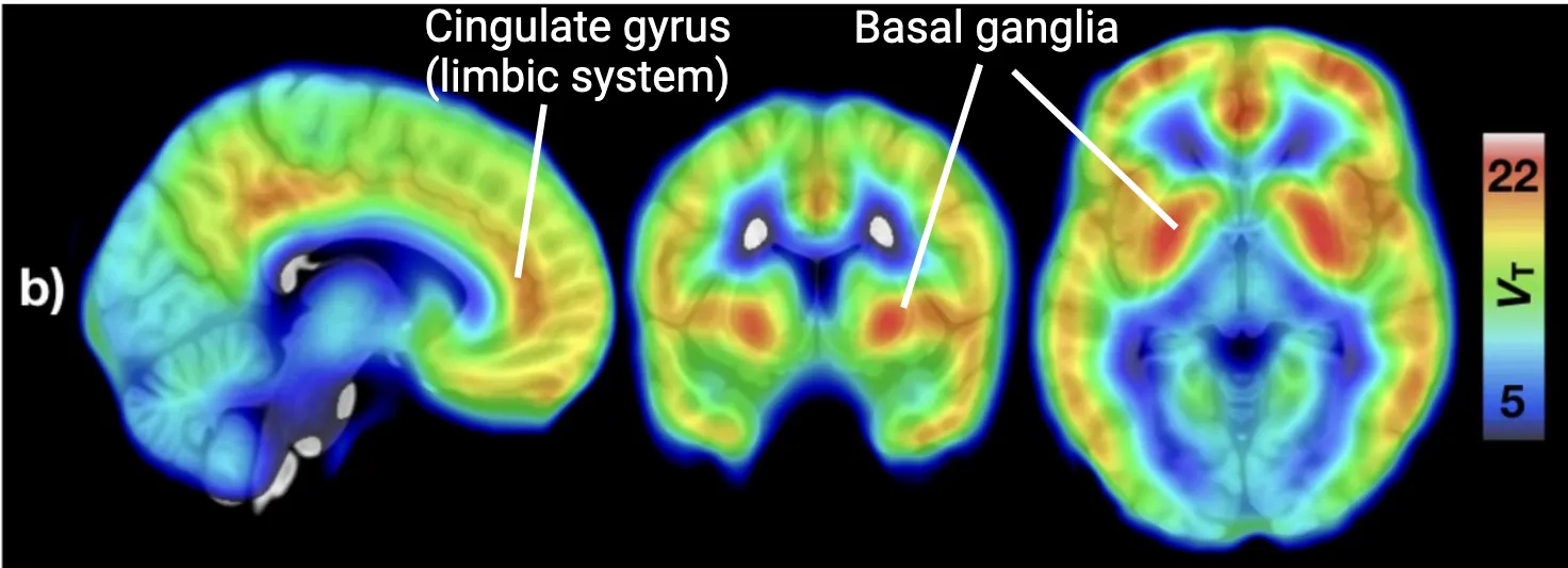 PET images of human brains with sagittal, coronal and horizontal view show abundant coloring to indicate receptor binding particularly in the cingulate gyrus and basal ganglia.