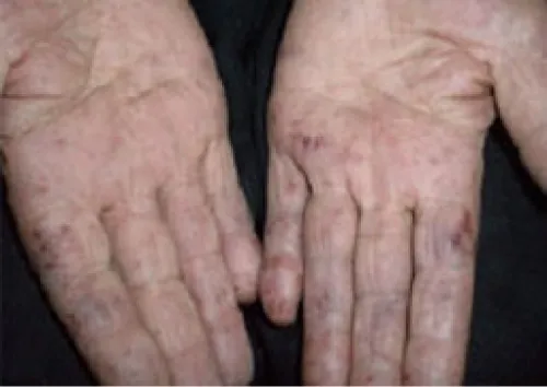 Photo of symmetrical mottling of fingers on a hand.