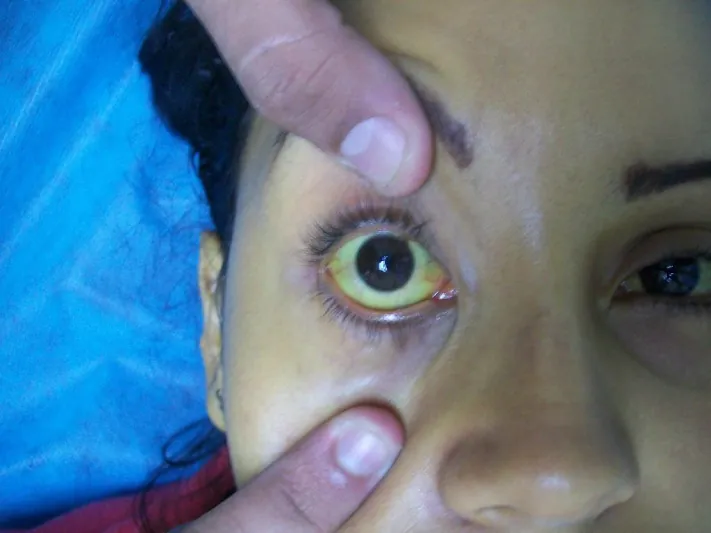 Eye showing jaundice.