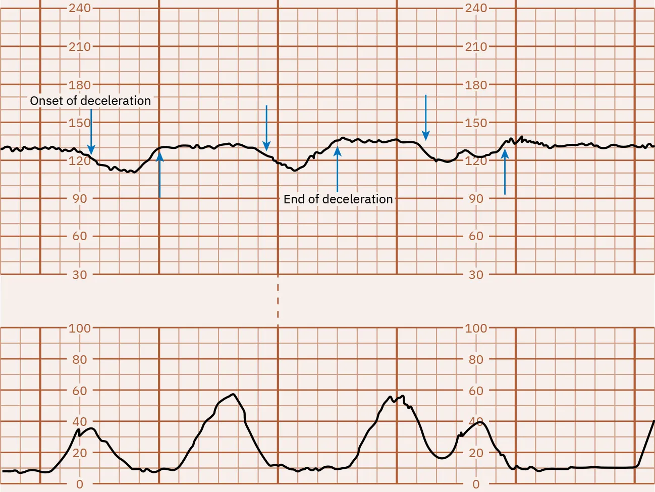 Fetal heart rate reading indicating late decelerations.