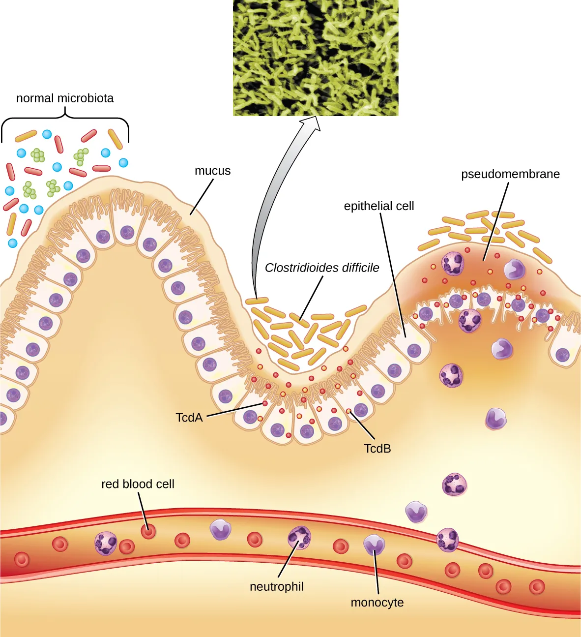A diagram showing the lining of the stomach. At the very bottom is a blood vessel with red blood cells, neutrophils, and monocytes. At the top is a wavy layer of epithelial cells covered in mucous. A variety of bacteria (different shapes and colors to indicate different species) are seen on the mucus. In one region is a cluster of rod shaped cells labeled Clostridioides difficile that release small dots labeled TcdA and TcdB. These create a pseudomembrane that is a swelling above destroyed epithelial cells. In response neutrophils and monocytes released.