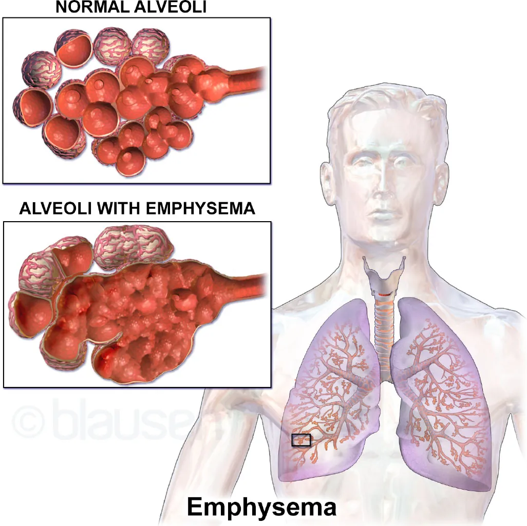 Diagram showing emphysema in lungs with insets showing normal alveoli and alveoli with emphysema.