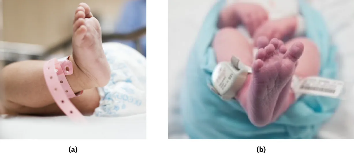 Infants with (a) identification band on ankle, and (b) anti-theft device on ankle.