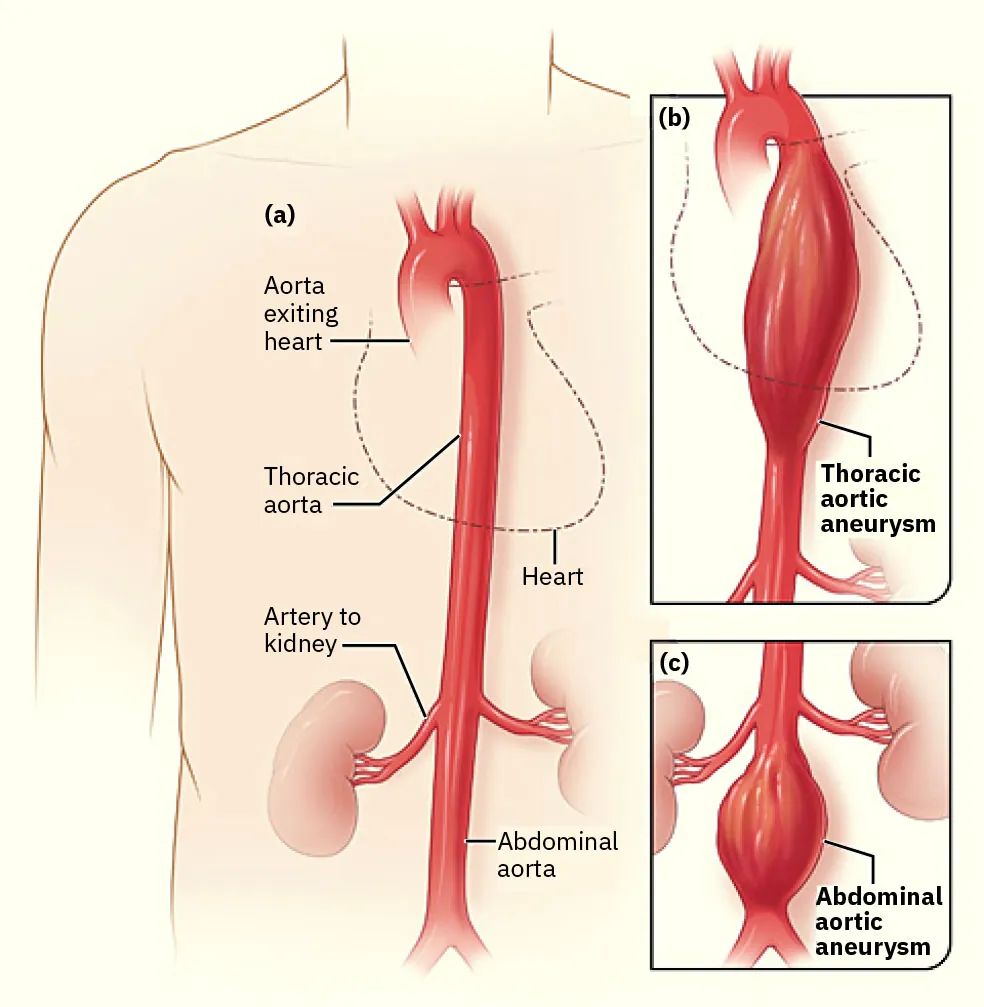 Diagram showing AAA, labeling Aorta exiting heart, Thoracic aorta, Heart, Artery to kidney, Abdominal aorta, Thoracic aortic aneurysm, and Abdominal aortic aneurysm.