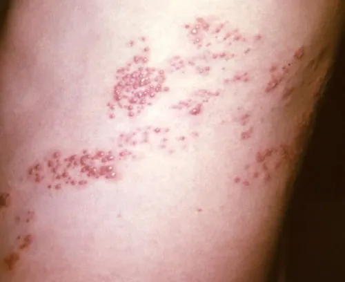 A close-up image showing a painful skin rash with clusters of small, red, fluid-filled blisters (vesicles) on a pale skin background, consistent with herpes zoster (shingles).