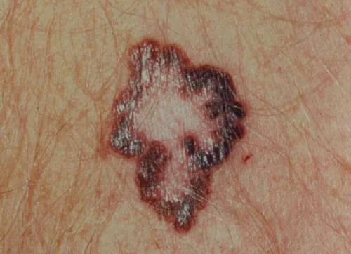 A color photograph of a mole with irregular borders