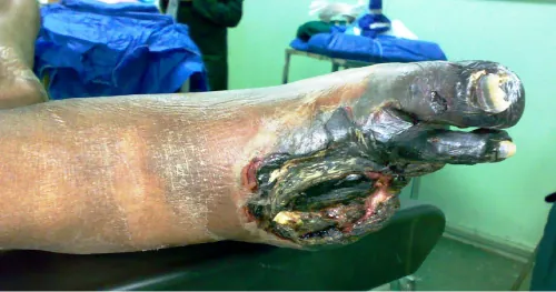 Image showing a foot with gangrene.