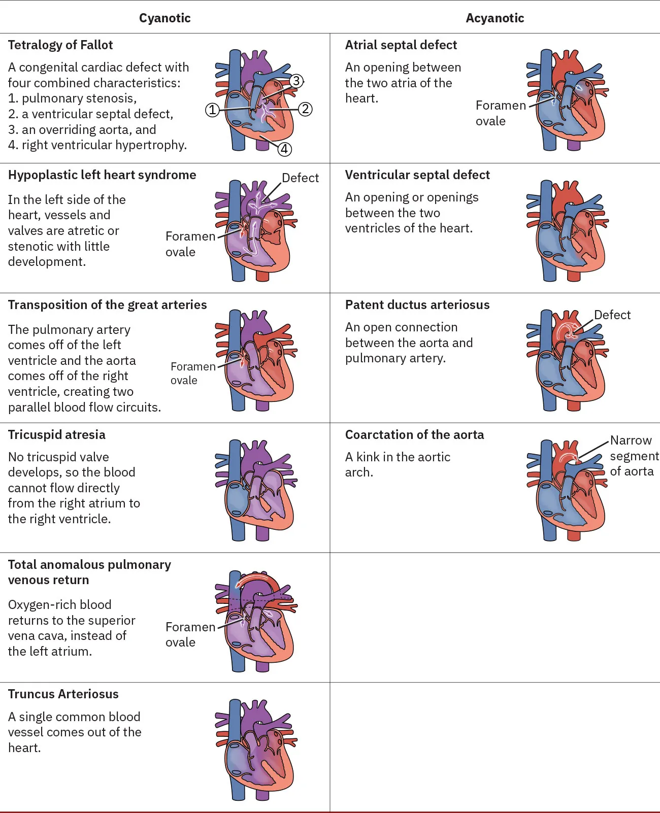 An educational diagram categorizing different congenital heart defects into cyanotic and acyanotic, with labeled illustrations showing the anatomy of each condition.