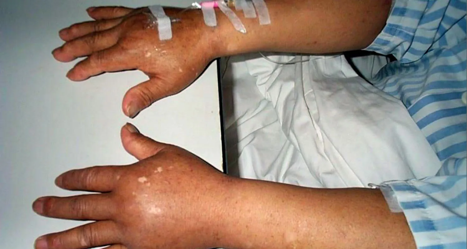 A photograph showing two very swollen hands. The swelling is in the core of the hands and in the fingers. The right hand has tape and an IV.