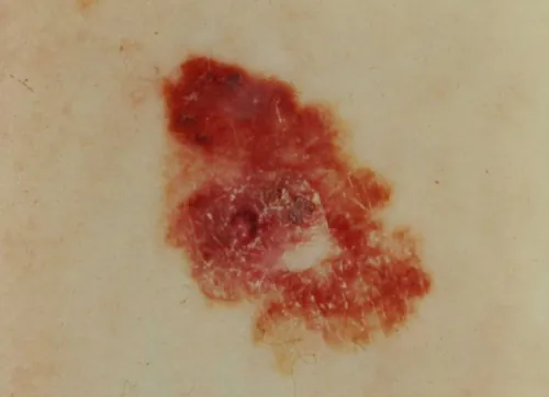 A color photograph of an asymmetric mole