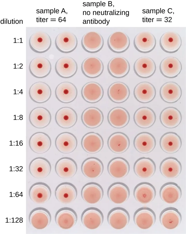 A drawing of a well plate. The label at the top reads: Dilution. The rows are labeled: 1:1, 1:2, 1:4, 1:8, 1:16, 1:32, 1:64, 1:128. The columns are labeled: Sample A, titer = 64 (this spans columns 1 and 2). Sample B, no neutralizing antibody (spans columns 3 and 4). Sample C, titer = 32 spans columns 5 and 6.). Columns 1 and 2 have red dots in all rows but the bottom one. Columns 3 and 4 have no red dots. Columns 5 and 6 have red dots in all rows but the bottom two.